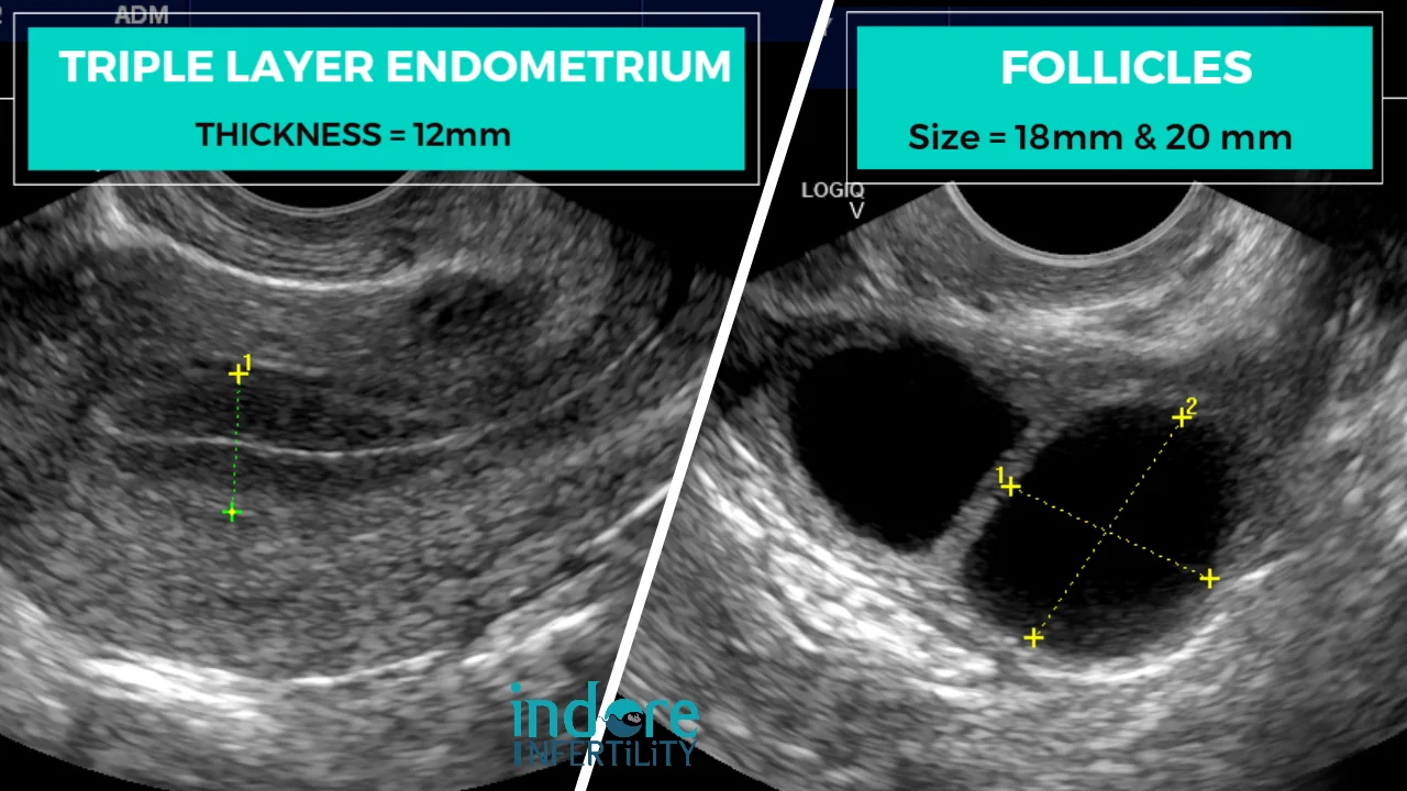 Ultrasound showing triple layer endometrium of 12mm and follicles of 18mm and 20mm
