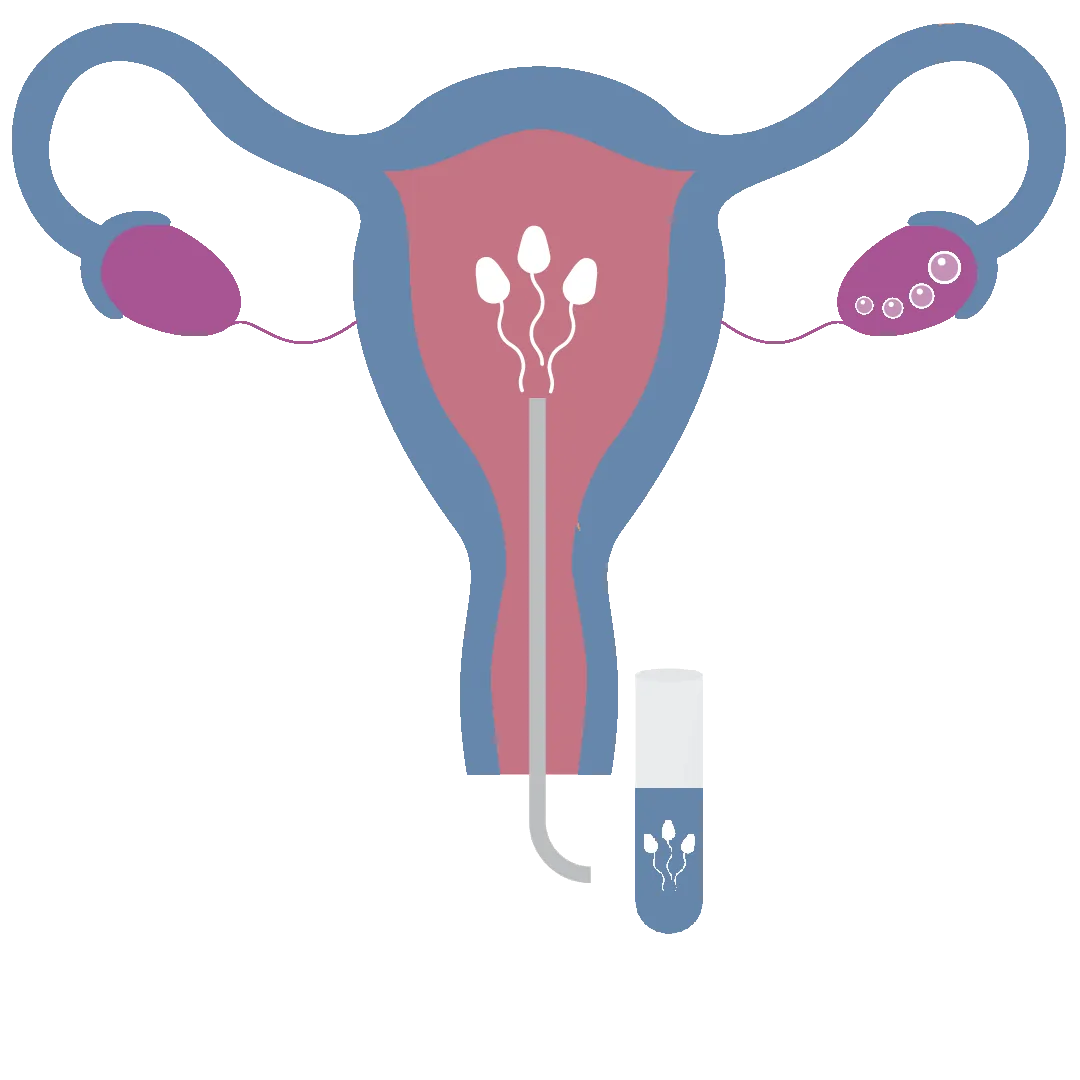 IUI Procedure