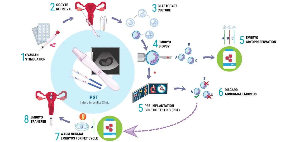 PGT IVF cycle showing ovarian stimulation embryo biopsy genetic testing cryopreservation and embryo transfer