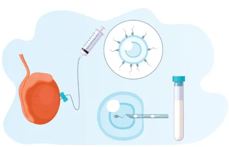 tesa pesa sperm extraction